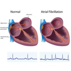 NUR108 - Atrial Fibrillation (1.5 HR)