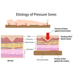 NUR187 - Pressure Ulcers: Etiology (2.5 HR)