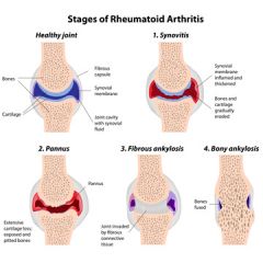CNA200 - CMA: Rheumatoid Arthritis (1.0 HR)