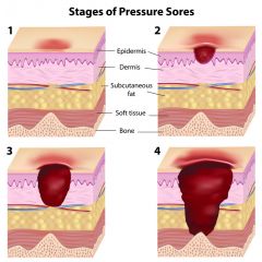 NUR182 - Pressure Ulcers (1.0 HR)