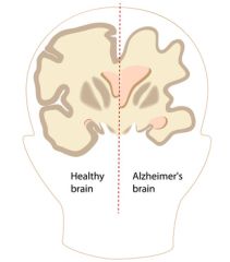 CNA106 - Caring for the Alzheimer's Patient (1.0 HR)