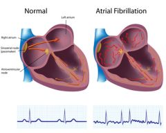 NUR108 - Atrial Fibrillation (1.5 HR)