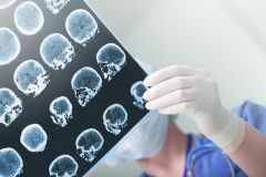 CNA202 - CMA: Stroke Care (1.5 HR)