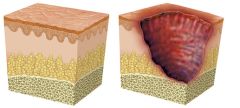 NUR181 - F686 Preventing Pressure Ulcers (1.0 HR)